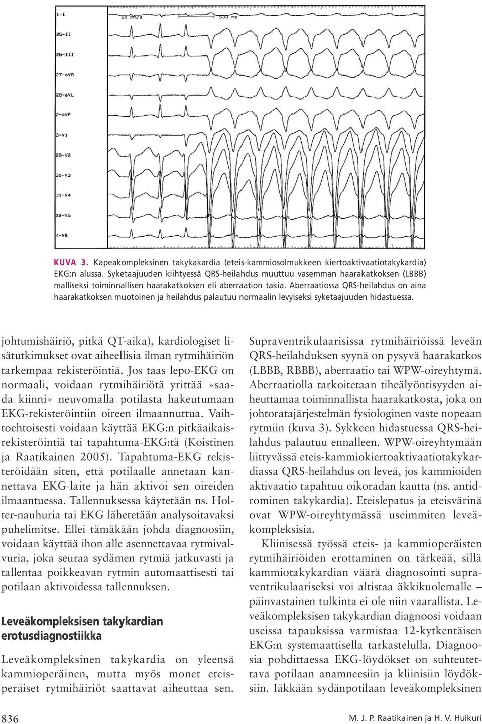 Aberraatiossa QRS heilahdus on aina haarakatkoksen muotoinen ja heilahdus palautuu normaalin levyiseksi syketaajuuden hidastuessa.