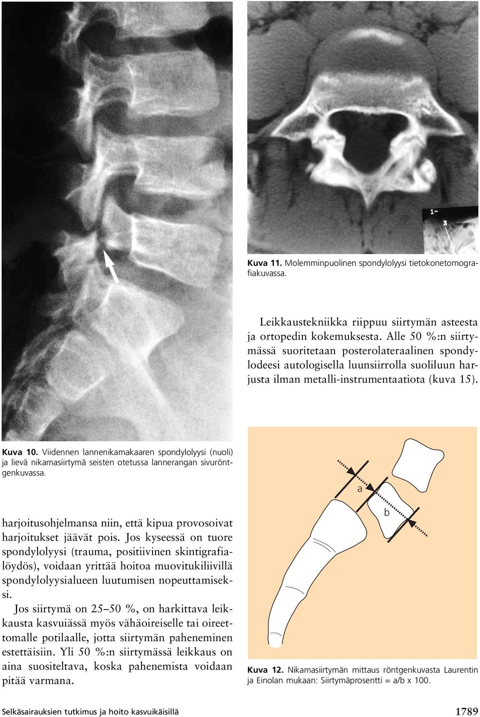 Viidennen lannenikamakaaren spondylolyysi (nuoli) ja lievä nikamasiirtymä seisten otetussa lannerangan sivuröntgenkuvassa. harjoitusohjelmansa niin, että kipua provosoivat harjoitukset jäävät pois.