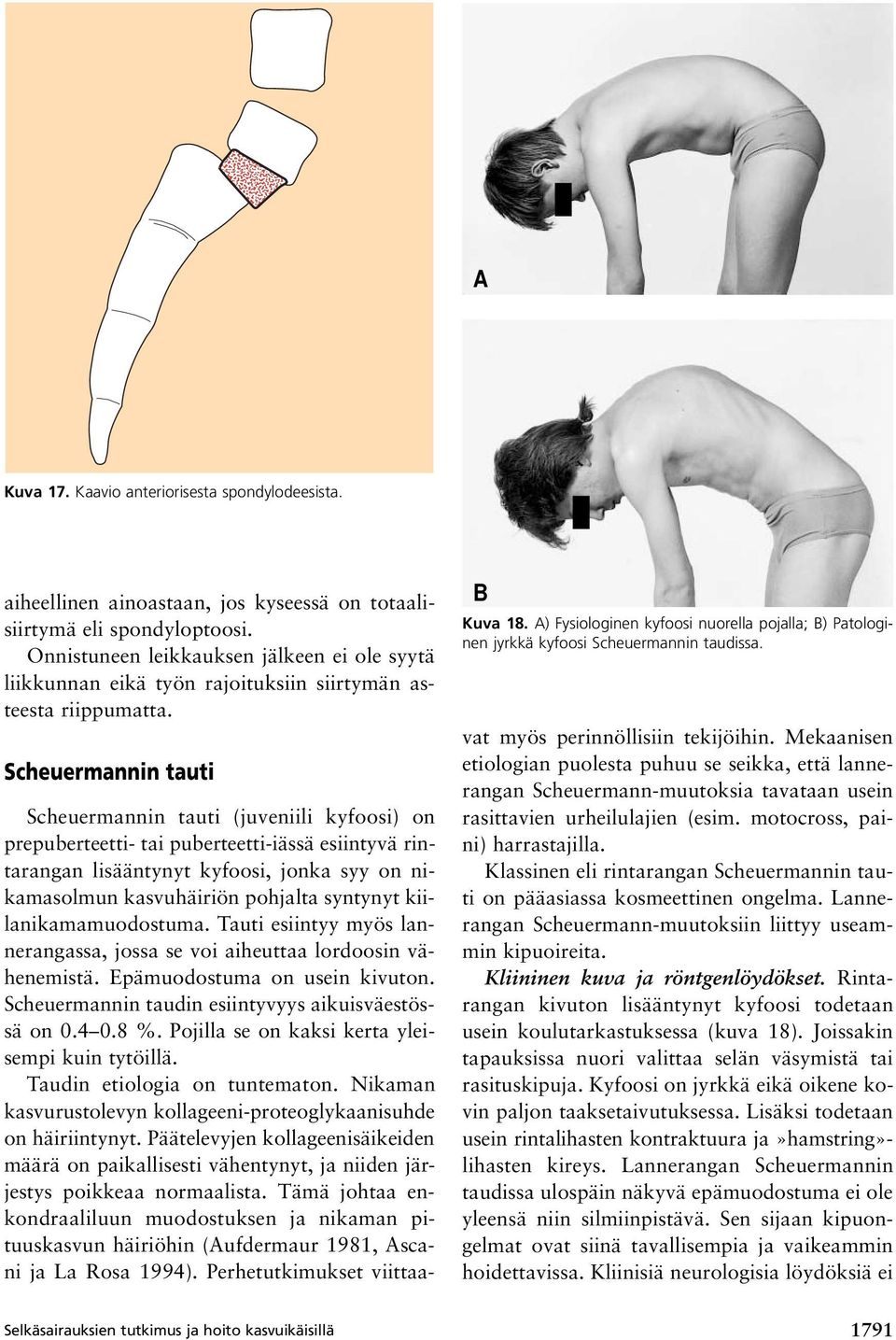 A) Fysiologinen kyfoosi nuorella pojalla; B) Patologinen jyrkkä kyfoosi Scheuermannin taudissa.