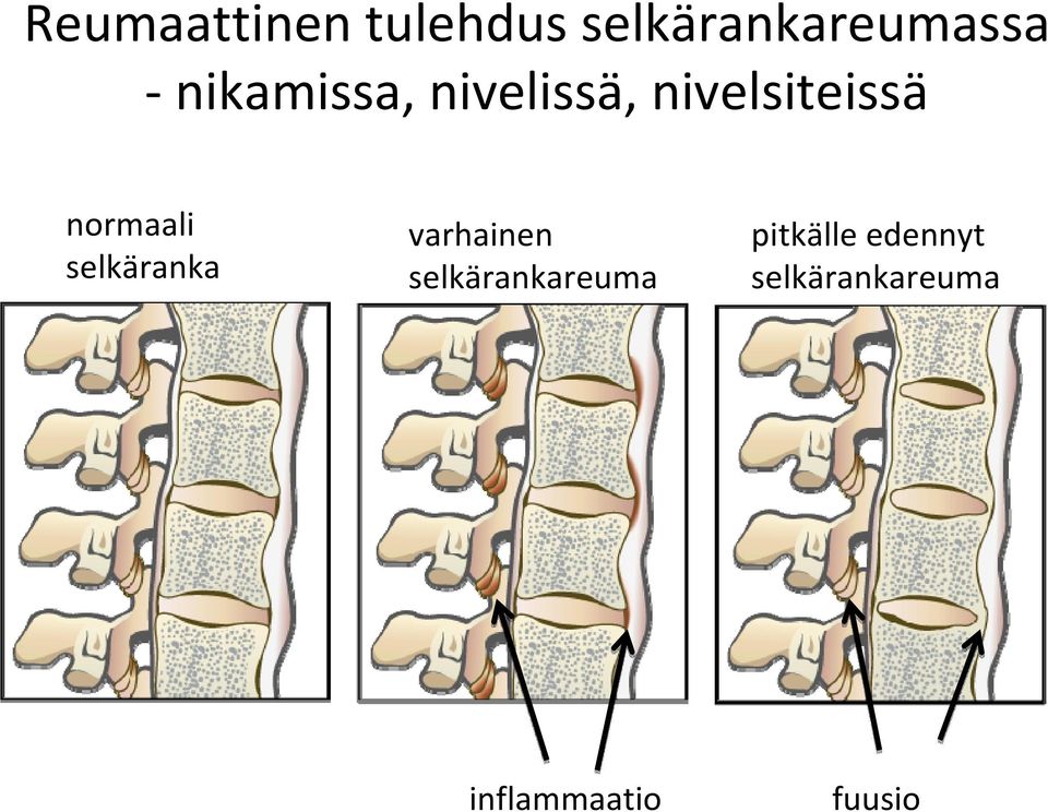 normaali selkäranka varhainen