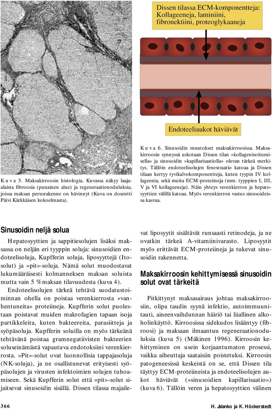 Sinusoidin muutokset maksakirroosissa. Maksakirroosin synnyssä uskotaan Dissen tilan»kollagenisoitumisella» ja sinusoidin»kapillarisaatiolla» olevan tärkeä merkitys.