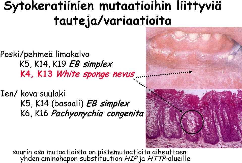 K5, K14 (basaali) EB simplex K6, K16 Pachyonychia congenita suurin osa