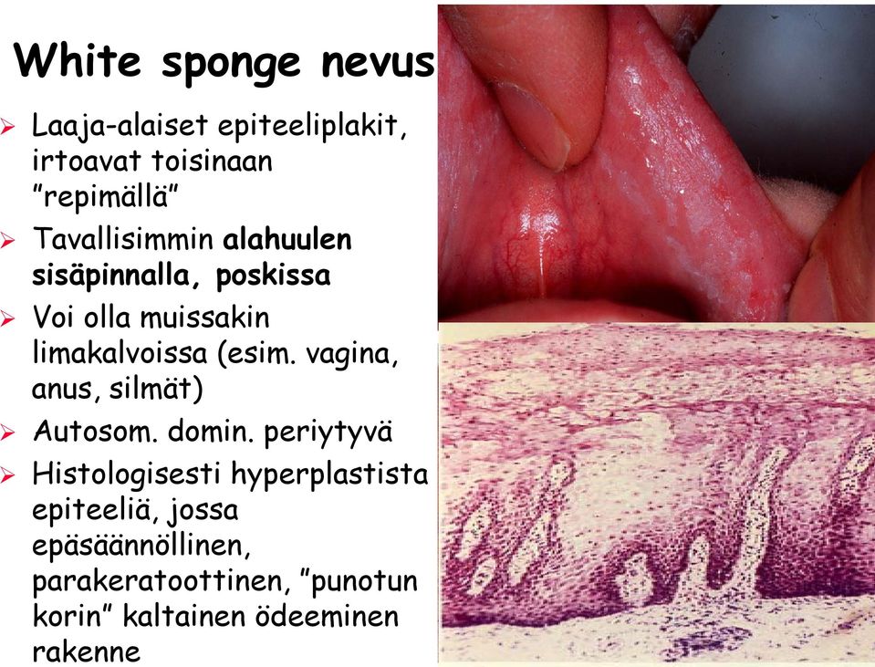 (esim. vagina, anus, silmät) Autosom. domin.
