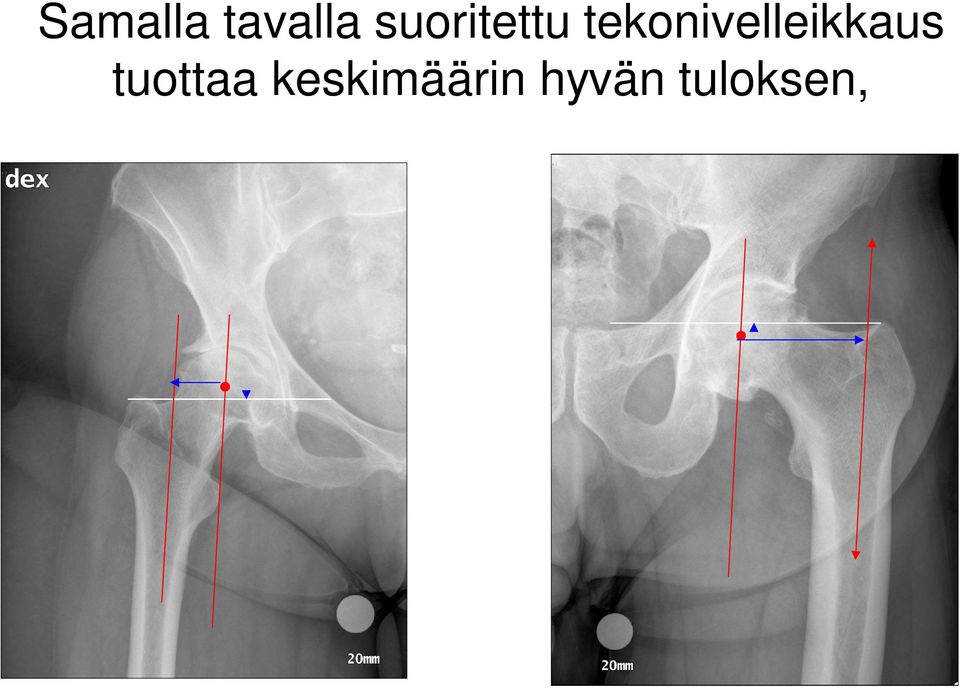tekonivelleikkaus