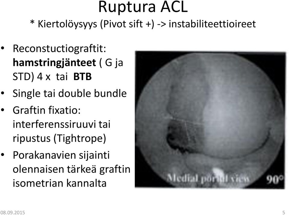 double bundle Graftin fixatio: interferenssiruuvi tai ripustus