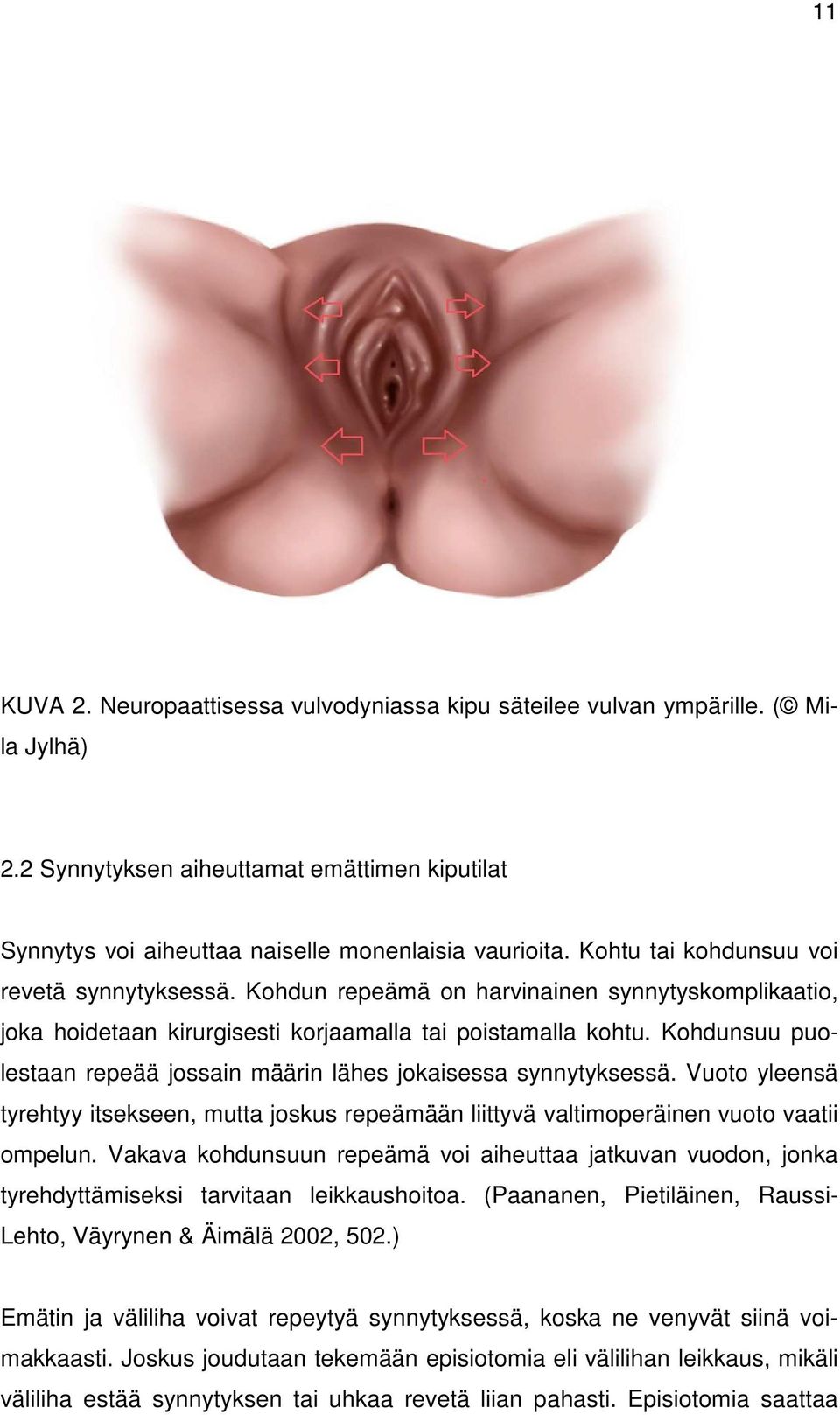 Kohdunsuu puolestaan repeää jossain määrin lähes jokaisessa synnytyksessä. Vuoto yleensä tyrehtyy itsekseen, mutta joskus repeämään liittyvä valtimoperäinen vuoto vaatii ompelun.