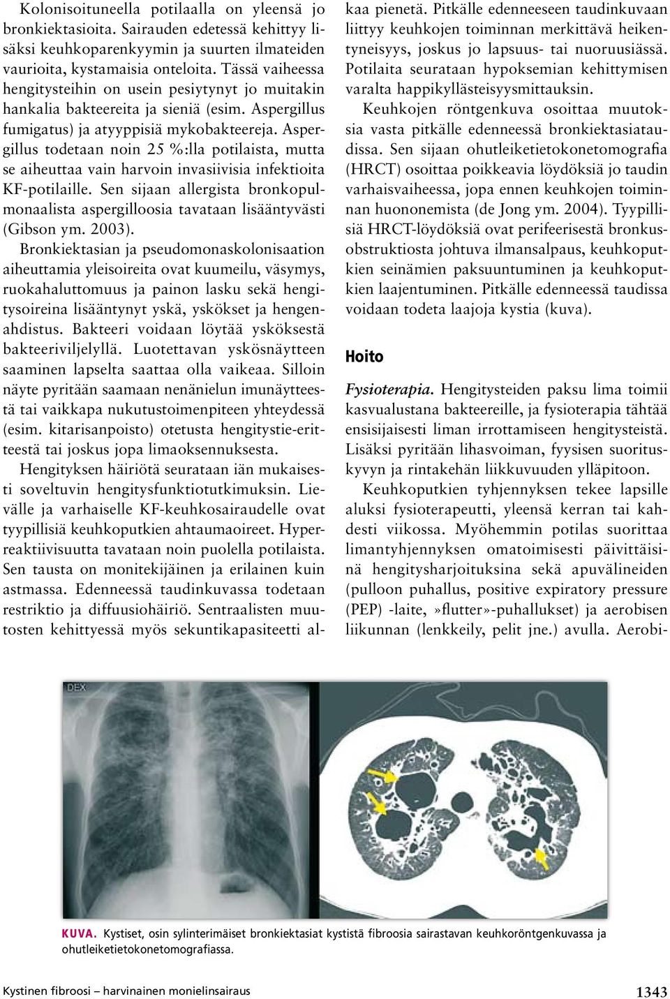 Aspergillus todetaan noin 25 %:lla potilaista, mutta se aiheuttaa vain harvoin invasiivisia infektioita KF potilaille.