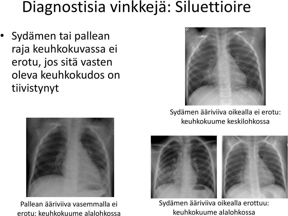 oikealla ei erotu: keuhkokuume keskilohkossa Pallean ääriviiva vasemmalla ei
