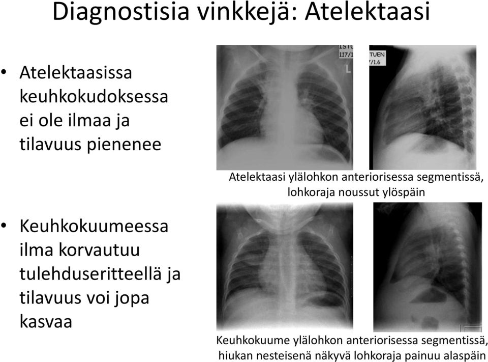 ylöspäin Keuhkokuumeessa ilma korvautuu tulehduseritteellä ja tilavuus voi jopa kasvaa