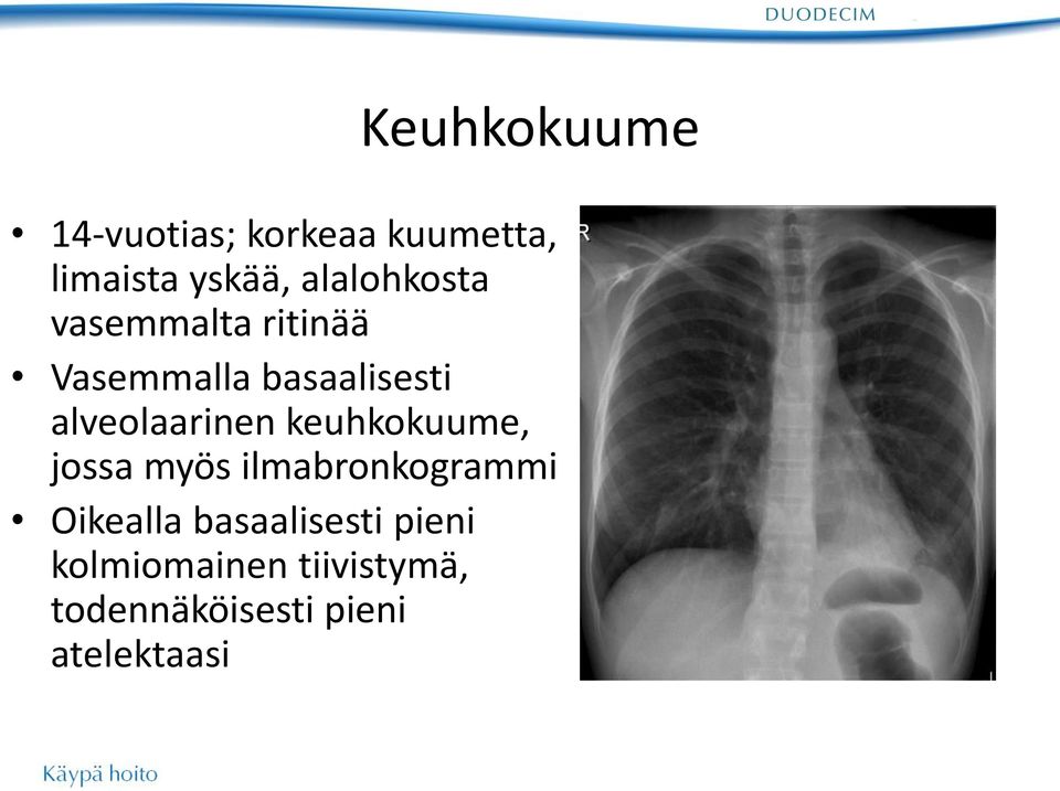 alveolaarinen keuhkokuume, jossa myös ilmabronkogrammi Oikealla