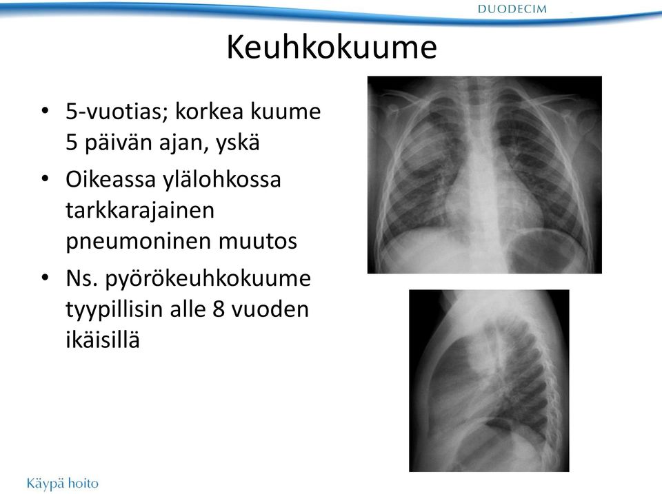 pneumoninen muutos Ns.