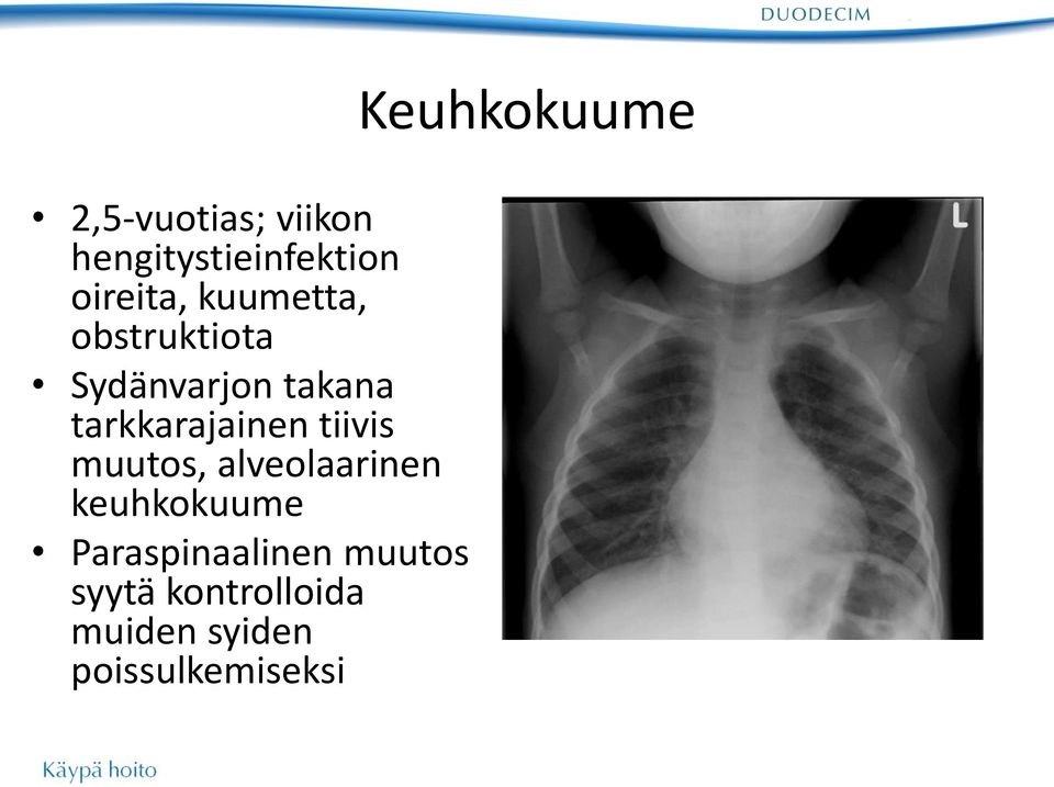 tiivis muutos, alveolaarinen keuhkokuume Paraspinaalinen