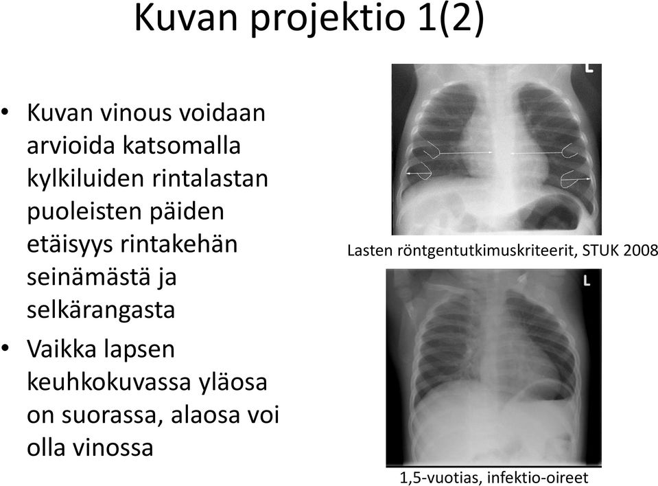 selkärangasta Vaikka lapsen keuhkokuvassa yläosa on suorassa, alaosa voi