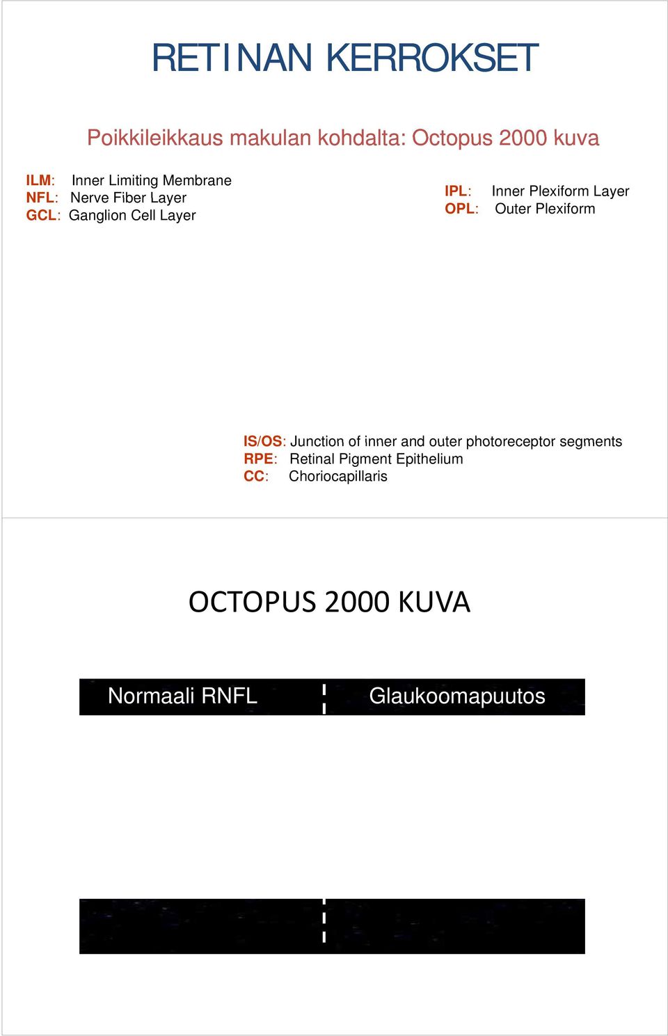 Plexiform Layer Outer Plexiform IS/OS: Junction of inner and outer photoreceptor