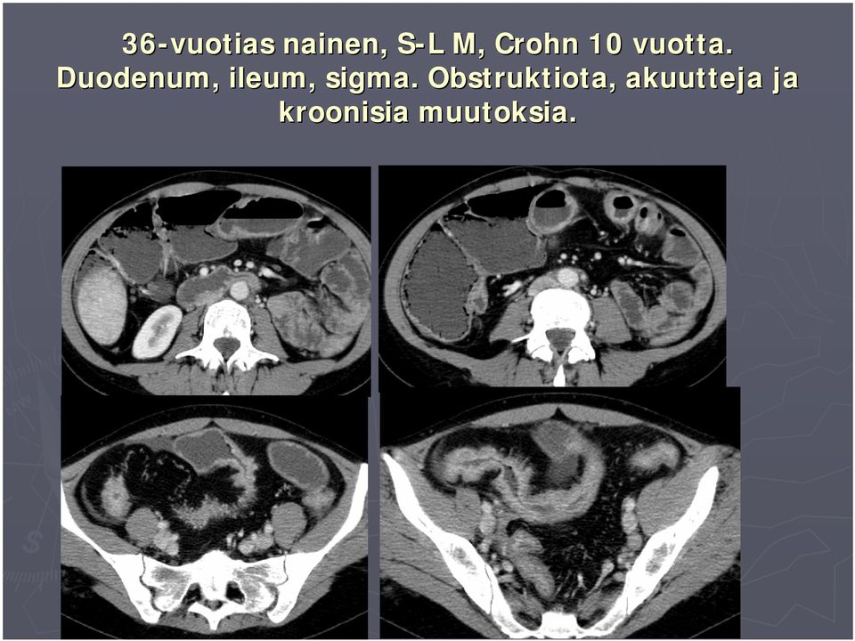 Duodenum, ileum,, sigma.