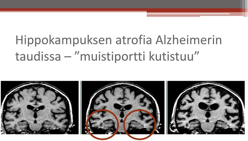 Alzheimerin