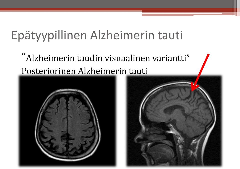 visuaalinen variantti