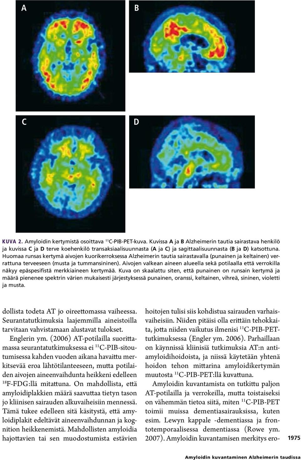 Huomaa runsas kertymä aivojen kuorikerroksessa Alzheimerin tautia sairastavalla (punainen ja keltainen) verrattuna terveeseen (musta ja tummansininen).