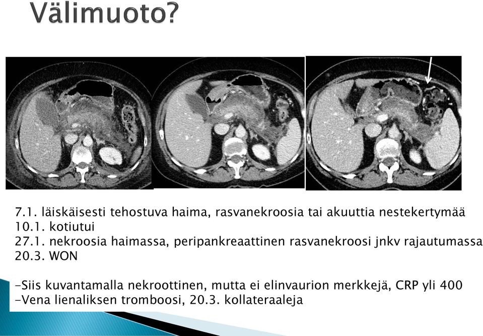 .1. kotiutui 27.1. nekroosia haimassa, peripankreaattinen rasvanekroosi