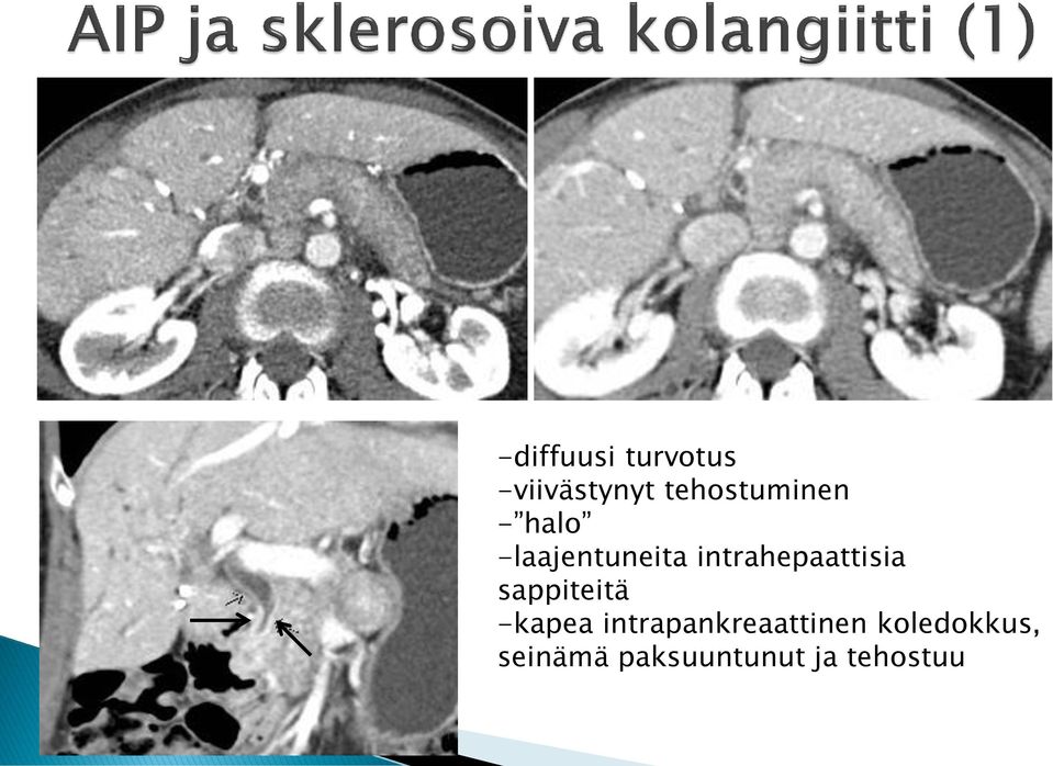 intrahepaattisia sappiteitä -kapea