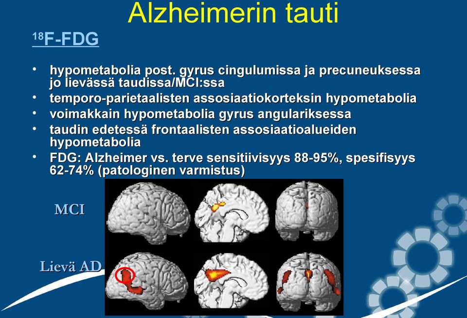 assosiaatiokorteksin hypometabolia voimakkain hypometabolia gyrus angulariksessa taudin