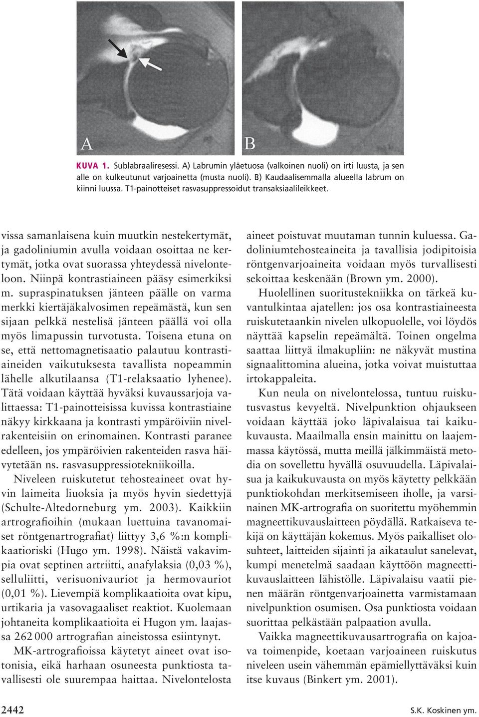 vissa samanlaisena kuin muutkin nestekertymät, ja gadoliniumin avulla voidaan osoittaa ne kertymät, jotka ovat suorassa yhteydessä nivelonteloon. Niinpä kontrastiaineen pääsy esimerkiksi m.