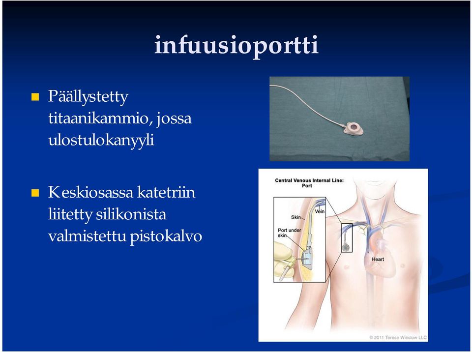 ulostulokanyyli Keskiosassa