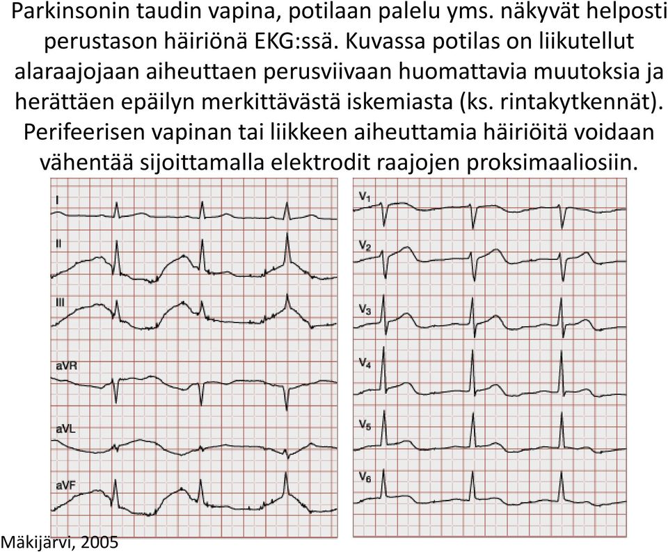herättäen epäilyn merkittävästä iskemiasta (ks. rintakytkennät).
