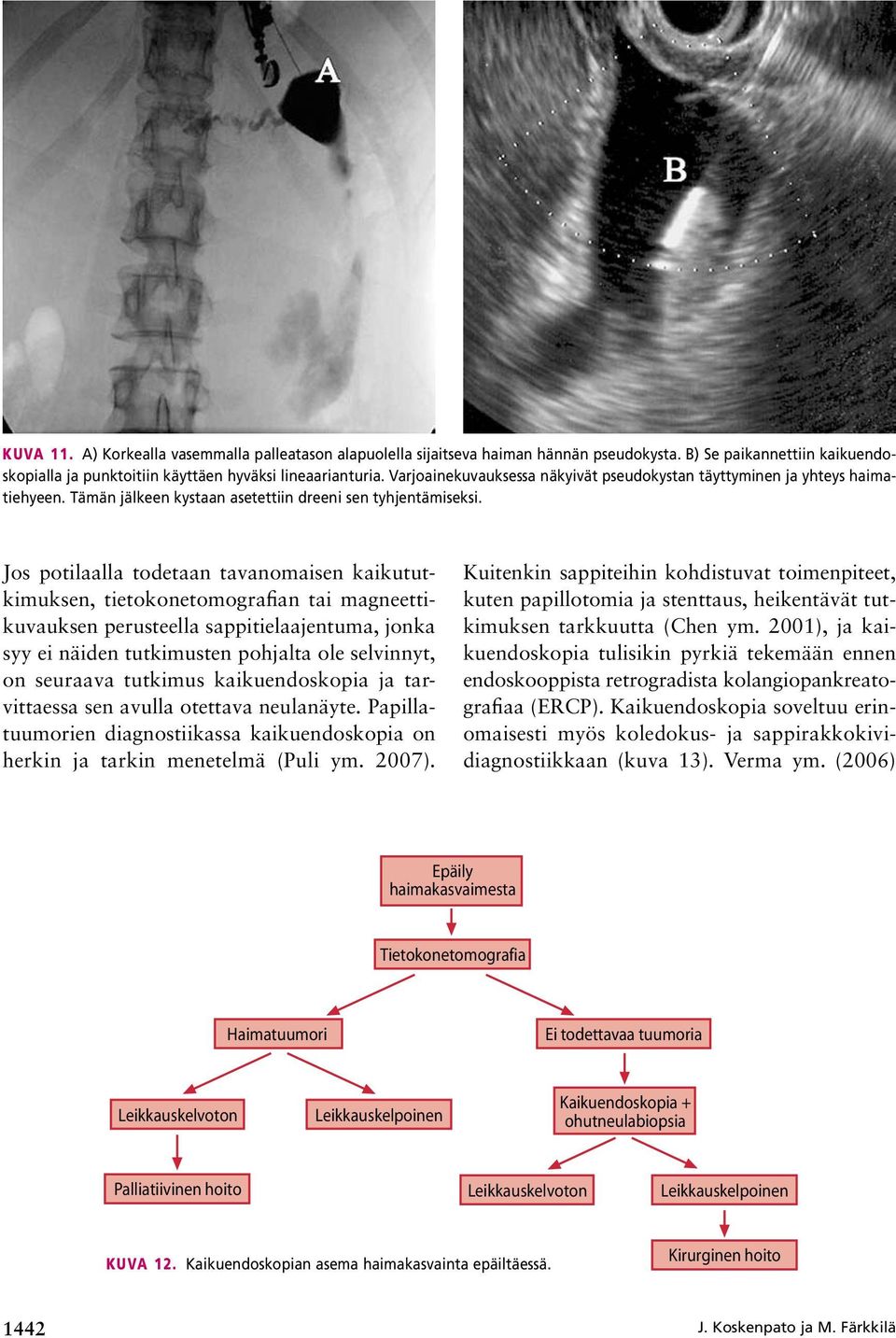 Jos potilaalla todetaan tavanomaisen kaikututkimuksen, tietokonetomografian tai magneettikuvauksen perusteella sappitielaajentuma, jonka syy ei näiden tutkimusten pohjalta ole selvinnyt, on seuraava