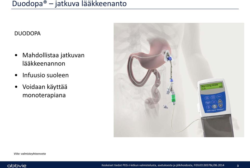 Infuusio suoleen Voidaan käyttää