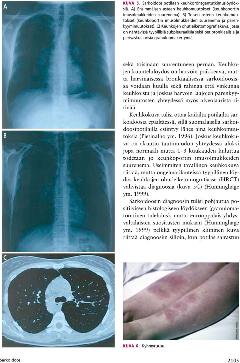 C) Keuhkojen ohutleiketomografiakuva, jossa on nähtävissä tyypillisiä subpleuraalisia sekä peribronkiaalisia ja perivaskulaarisia granuloomakertymiä. B sekä toisinaan suurentuneen pernan.