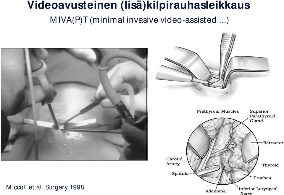 MIVA(P)T (minimal invasive