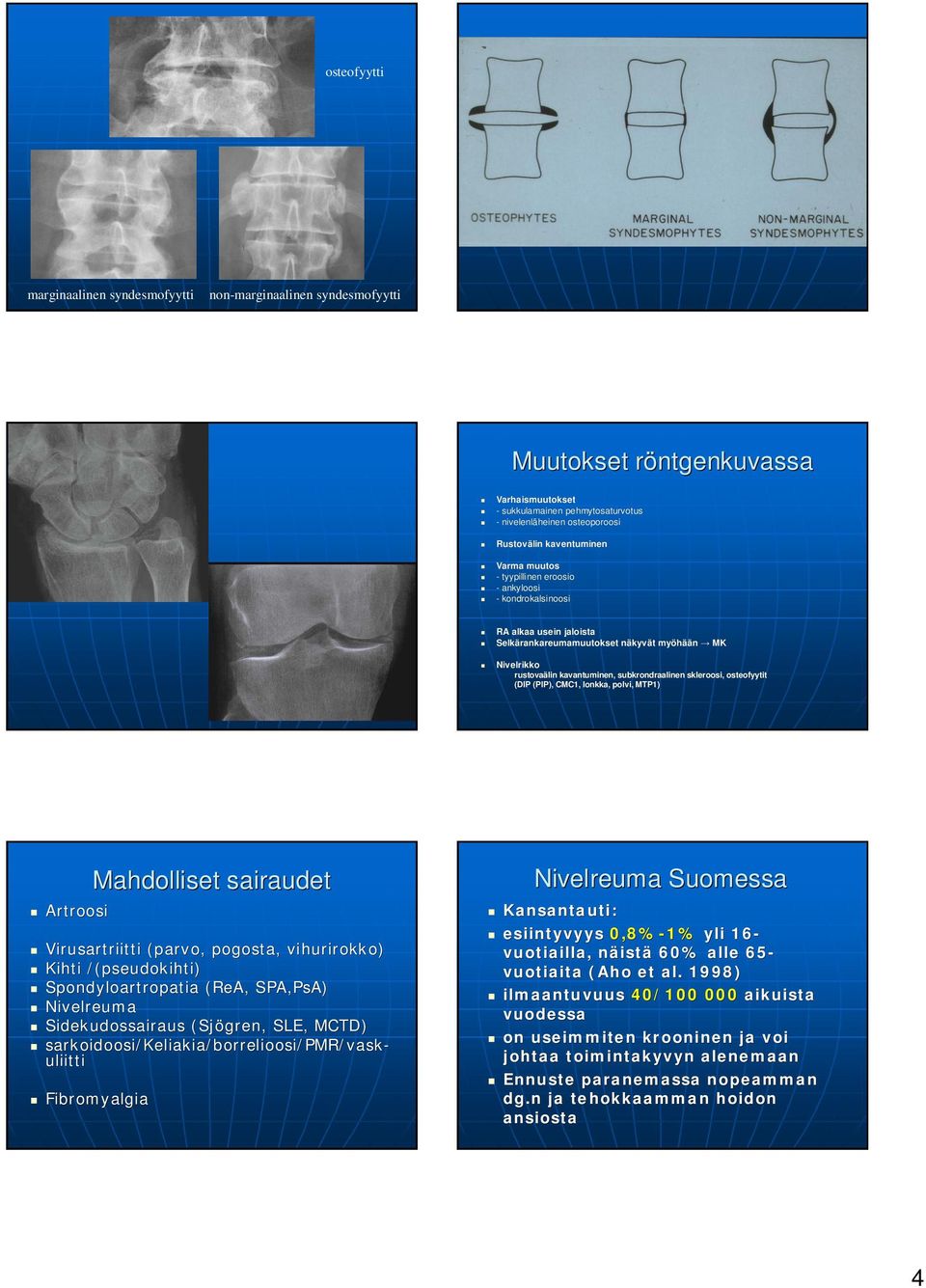 subkrondraalinen skleroosi, osteofyytit (DIP (PIP), CMC1, lonkka, polvi, MTP1) Artroosi Mahdolliset sairaudet Virusartriitti (parvo( parvo, pogosta,, vihurirokko) Kihti /(pseudokihti)