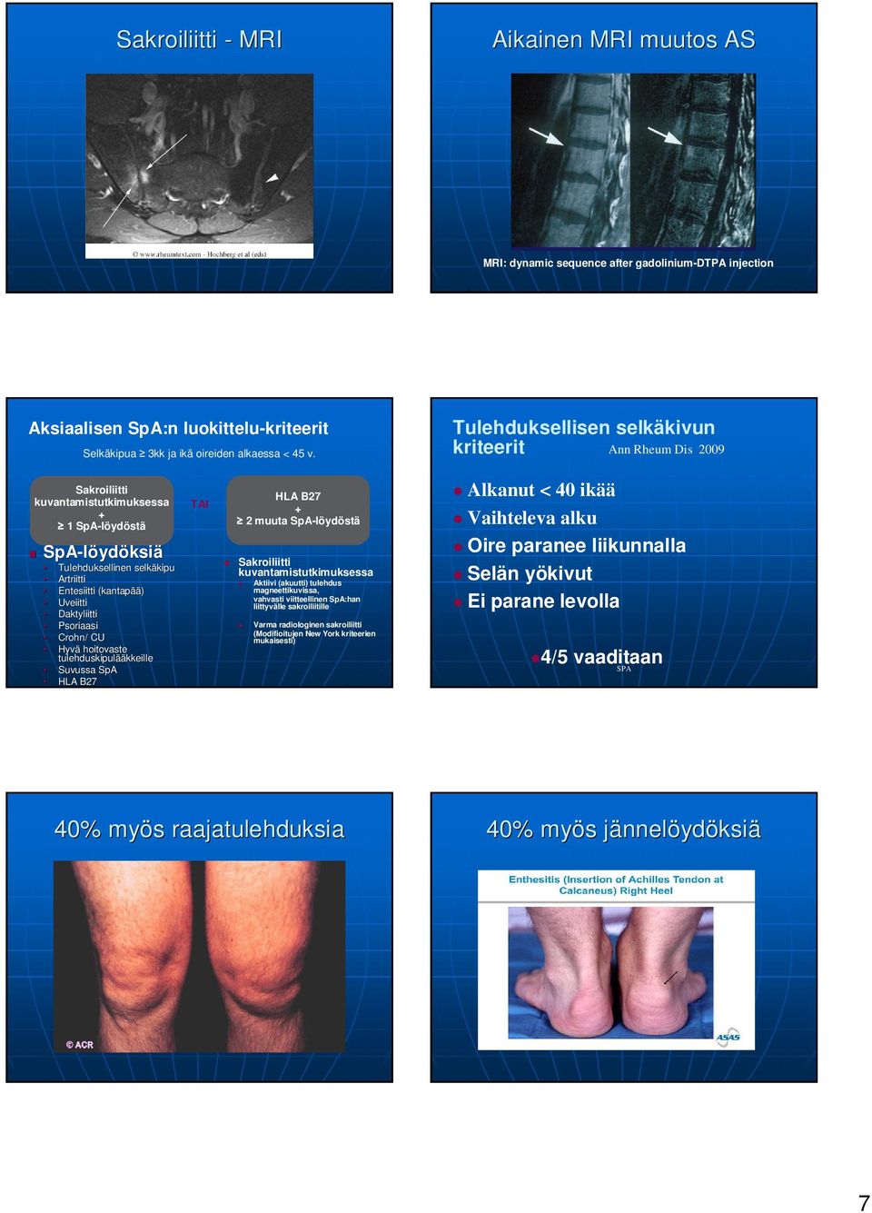 Uveiitti Daktyliitti Psoriaasi Crohn/ / CU Hyvä hoitovaste tulehduskipulää ääkkeille Suvussa SpA HLA B27 TAI HLA B27 + 2 muuta SpA-löydöstä Sakroiliitti kuvantamistutkimuksessa Aktiivi (akuutti)