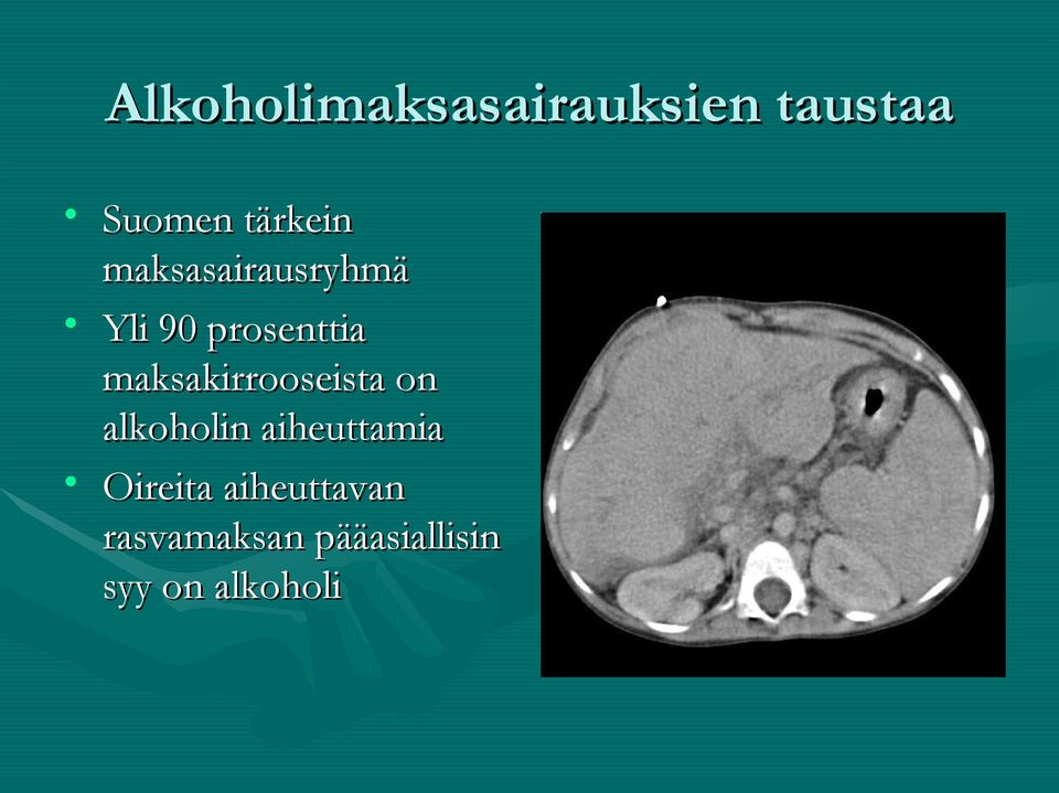 maksakirrooseista on alkoholin aiheuttamia