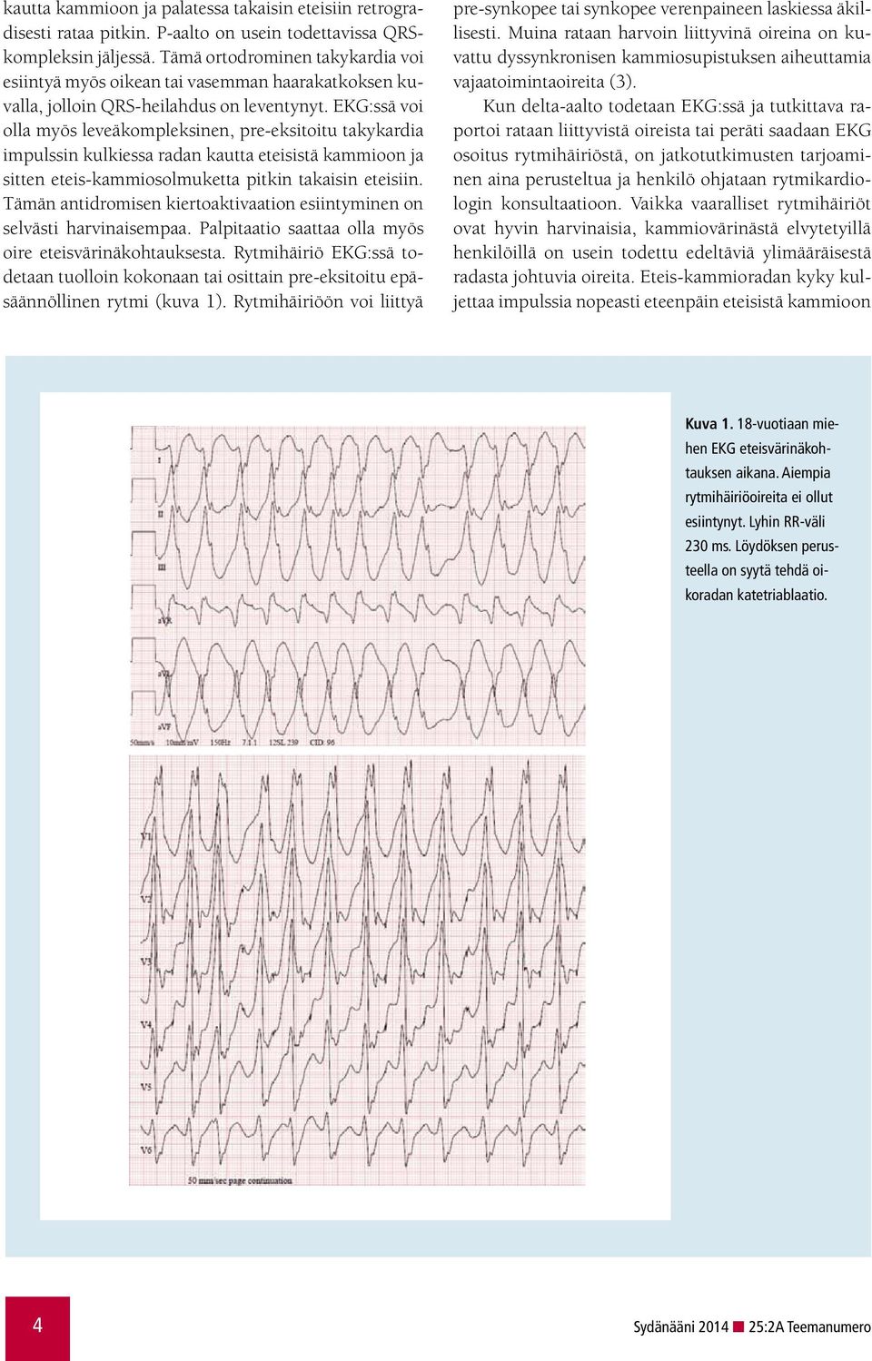 EKG:ssä voi olla myös leveäkompleksinen, pre-eksitoitu takykardia impulssin kulkiessa radan kautta eteisistä kammioon ja sitten eteis-kammiosolmuketta pitkin takaisin eteisiin.