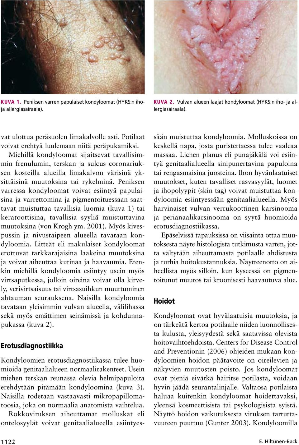 Miehillä kondyloomat sijaitsevat tavallisimmin frenulumin, terskan ja sulcus coronariuksen kosteilla alueilla limakalvon värisinä yksittäisinä muutoksina tai rykelminä.