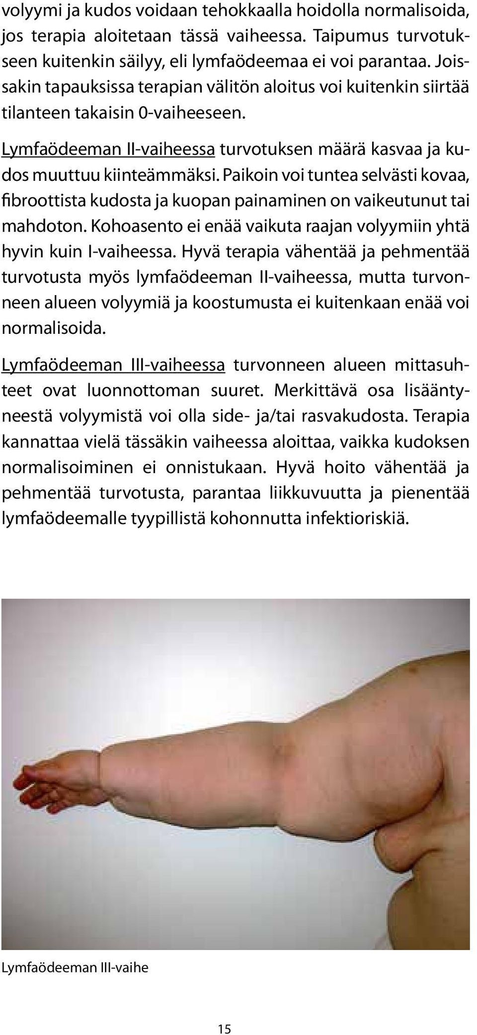 Paikoin voi tuntea selvästi kovaa, fibroottista kudosta ja kuopan painaminen on vaikeutunut tai mahdoton. Kohoasento ei enää vaikuta raajan volyymiin yhtä hyvin kuin I-vaiheessa.