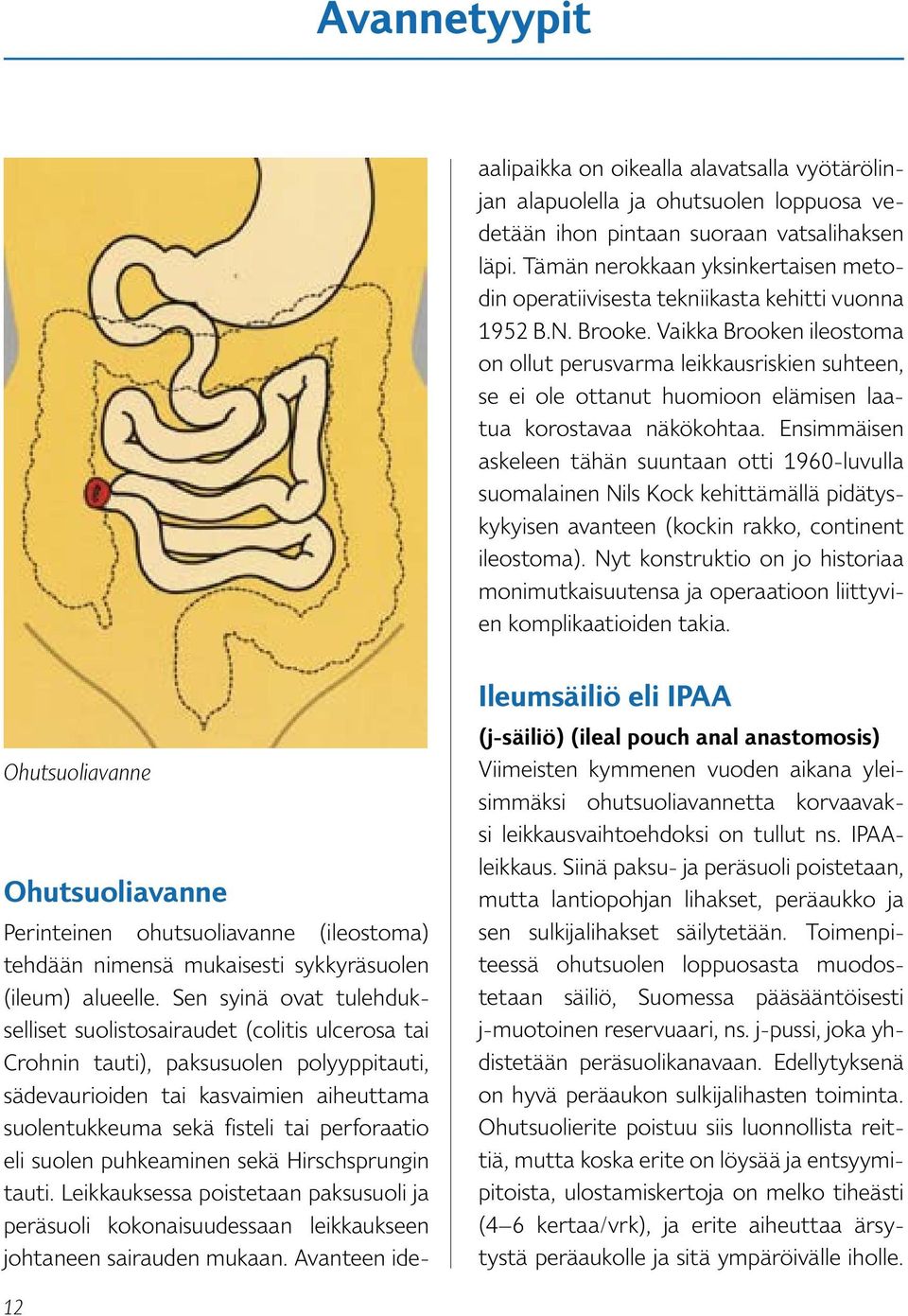 Vaikka Brooken ileostoma on ollut perusvarma leikkausriskien suhteen, se ei ole ottanut huomioon elämisen laatua korostavaa näkökohtaa.