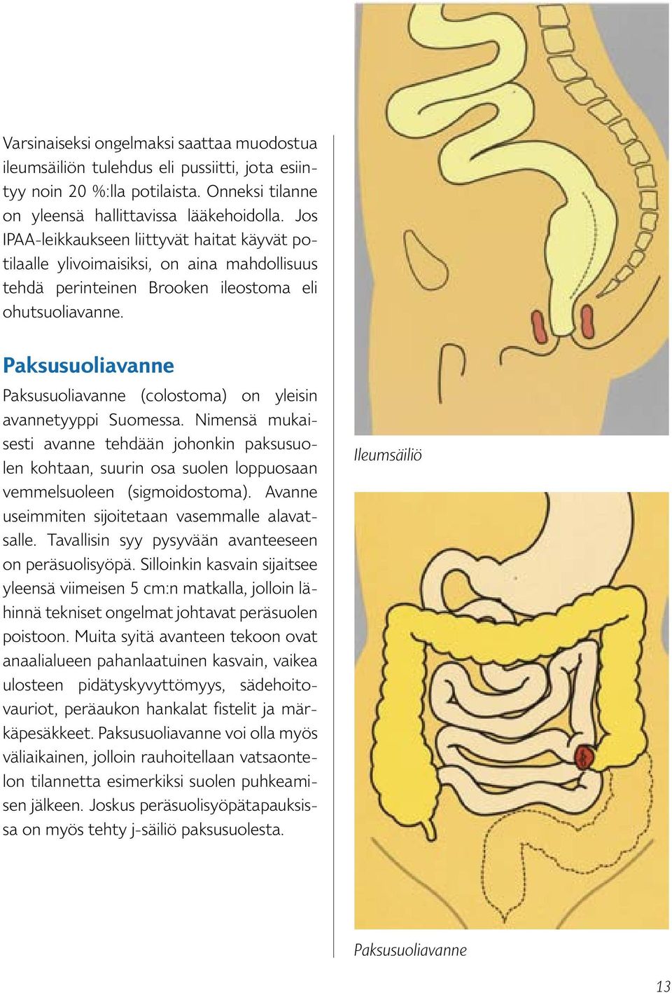 Paksusuoliavanne Paksusuoliavanne (colostoma) on yleisin avannetyyppi Suomessa.