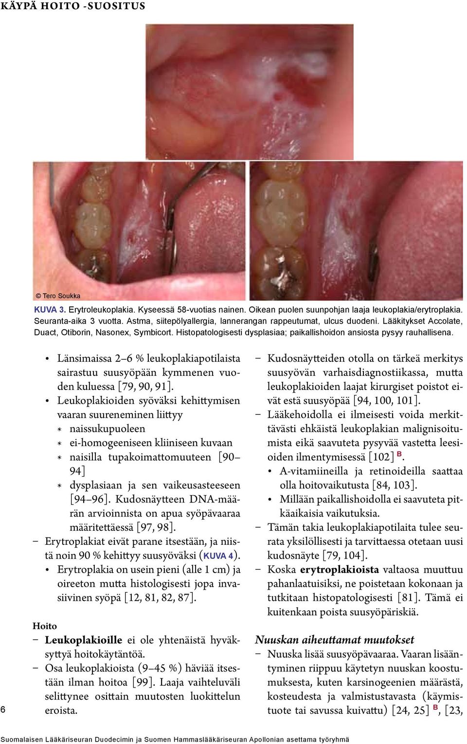 6 Länsimaissa 2 6 % leukoplakiapotilaista sairastuu suusyöpään kymmenen vuoden kuluessa [79, 90, 91].