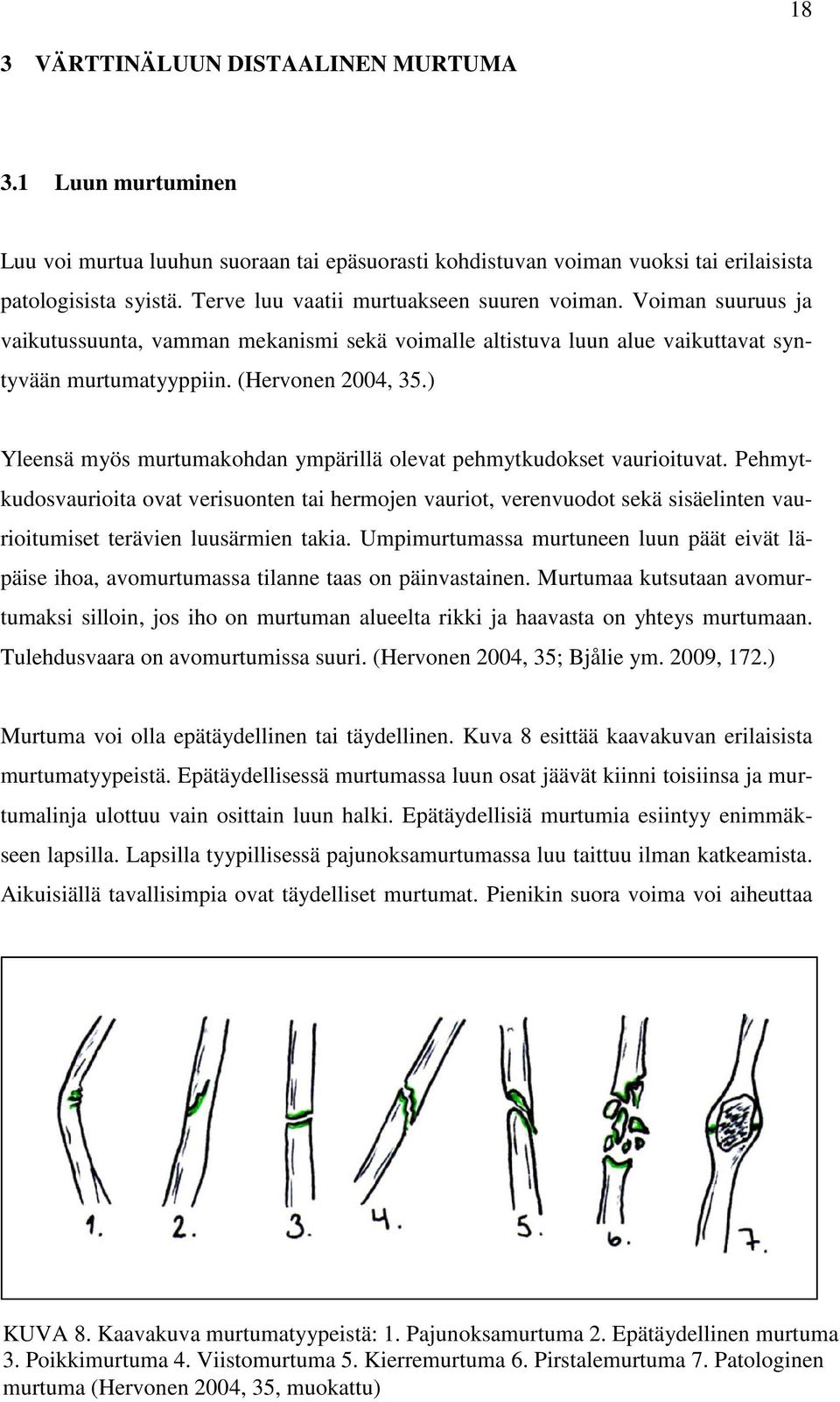 ) Yleensä myös murtumakohdan ympärillä olevat pehmytkudokset vaurioituvat.