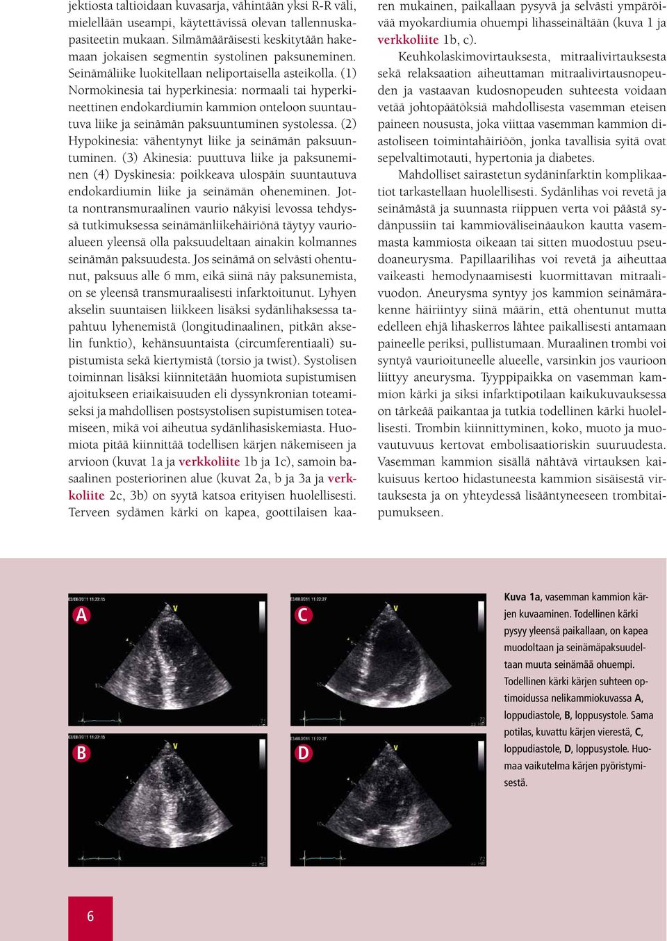 (1) Normokinesia tai hyperkinesia: normaali tai hyperkineettinen endokardiumin kammion onteloon suuntautuva liike ja seinämän paksuuntuminen systolessa.