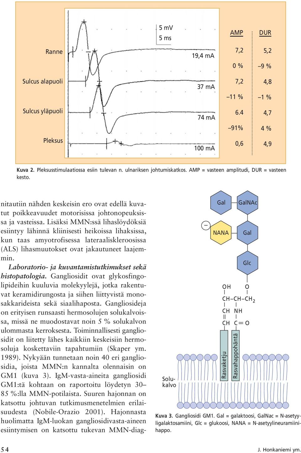 Lisäksi MMN:ssä lihaslöydöksiä esiintyy lähinnä kliinisesti heikoissa lihaksissa, kun taas amyotrofisessa lateraaliskleroosissa (ALS) lihasmuutokset ovat jakautuneet laajemmin.