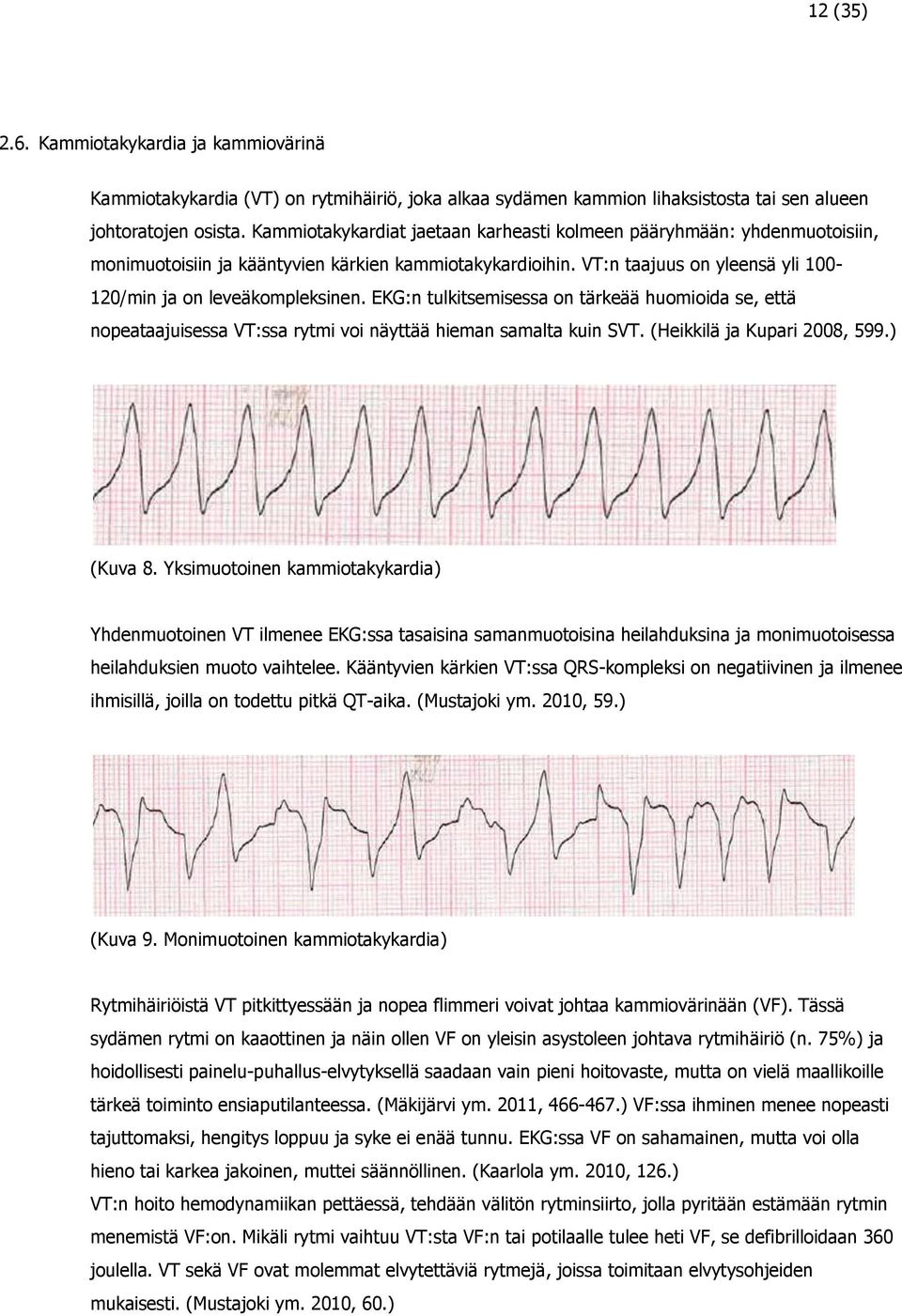 EKG:n tulkitsemisessa on tärkeää huomioida se, että nopeataajuisessa VT:ssa rytmi voi näyttää hieman samalta kuin SVT. (Heikkilä ja Kupari 2008, 599.) (Kuva 8.