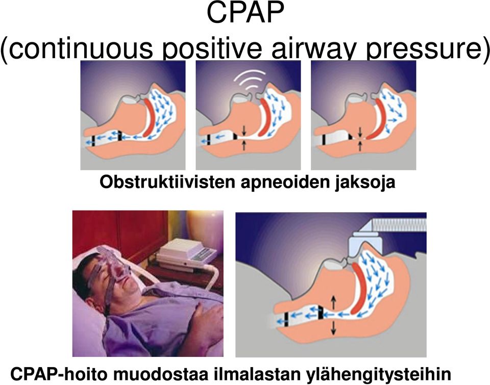 Obstruktiivisten apneoiden