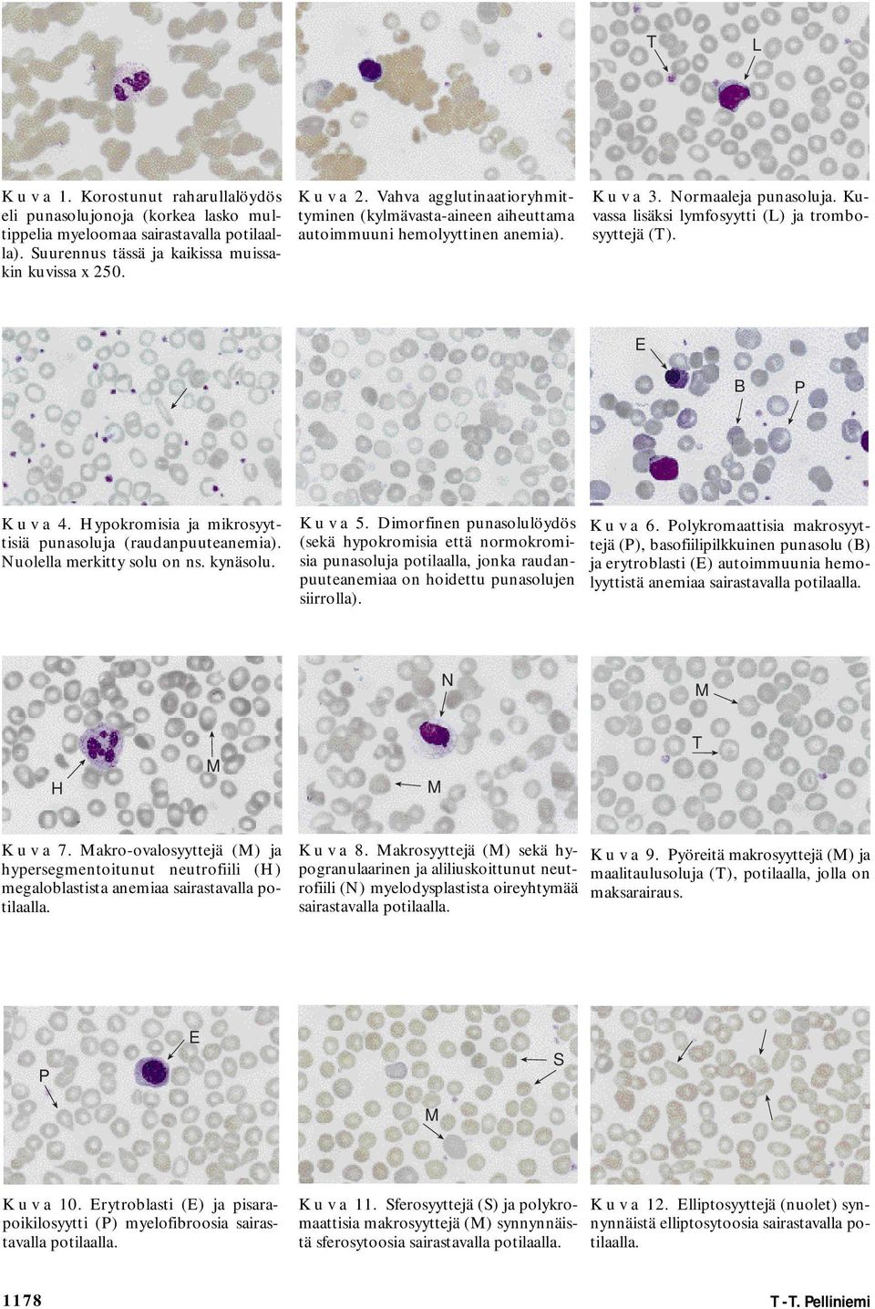 E B P K u v a 4. Hypokromisia ja mikrosyyttisiä punasoluja (raudanpuuteanemia). uolella merkitty solu on ns. kynäsolu. K u v a 5.