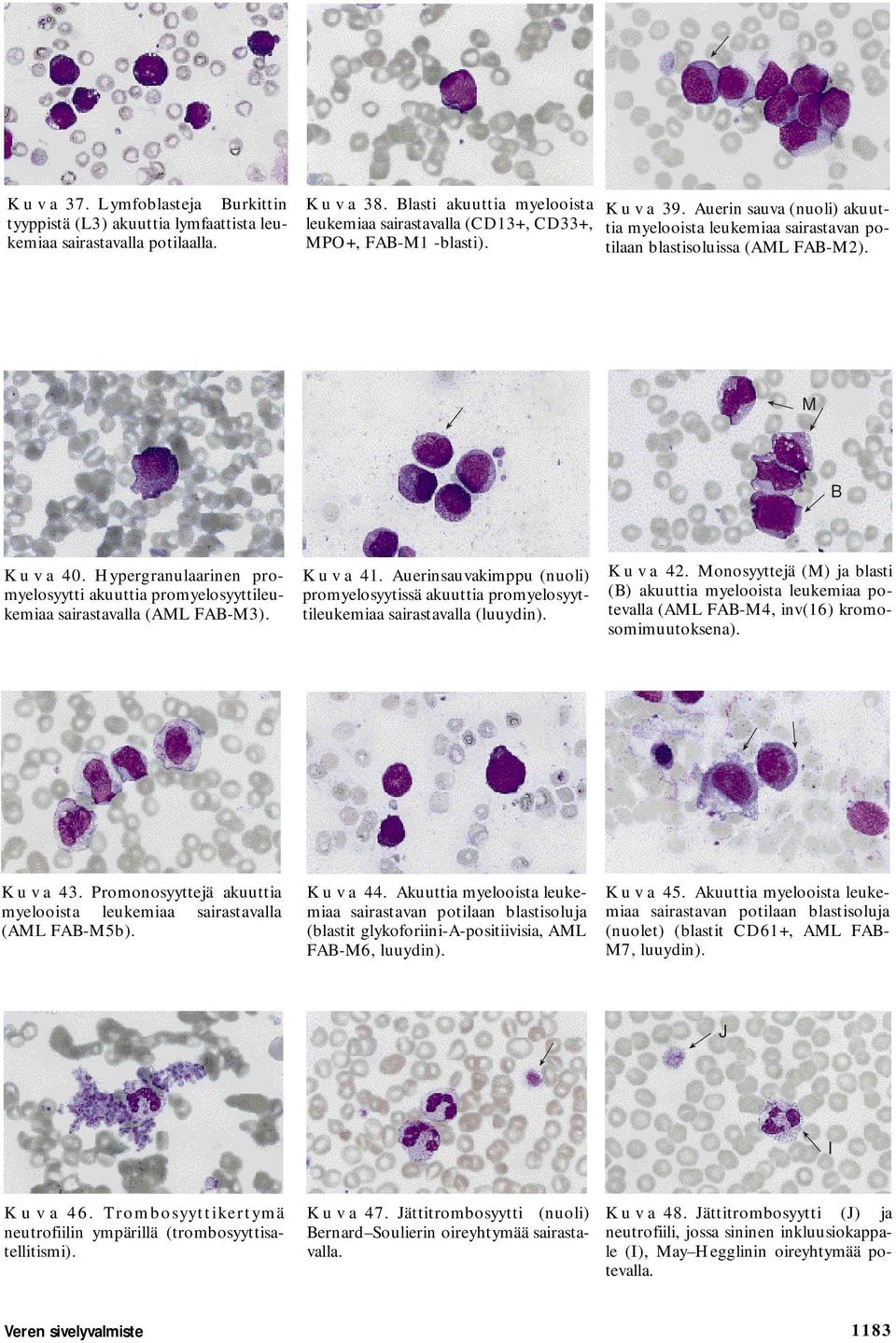 B K u v a 40. Hypergranulaarinen promyelosyytti akuuttia promyelosyyttileukemiaa sairastavalla (AL FAB-3). K u v a 41.