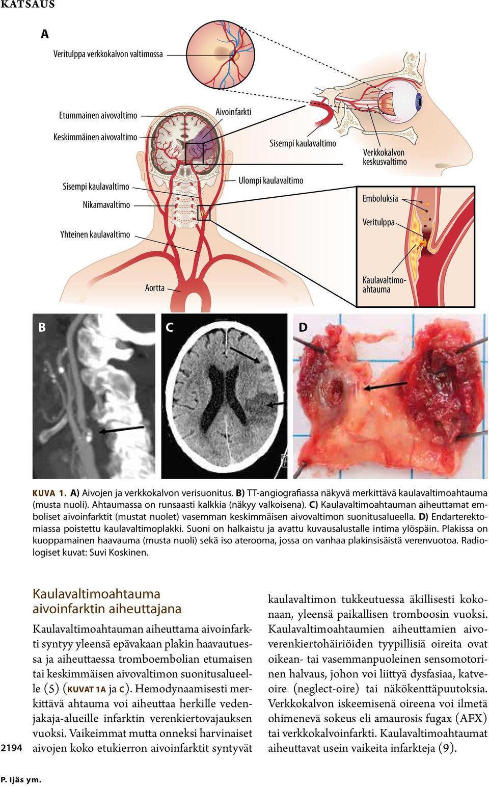 B) TT-angiografiassa näkyvä merkittävä kaulavaltimoahtauma (musta nuoli). Ahtaumassa on runsaasti kalkkia (näkyy valkoisena).