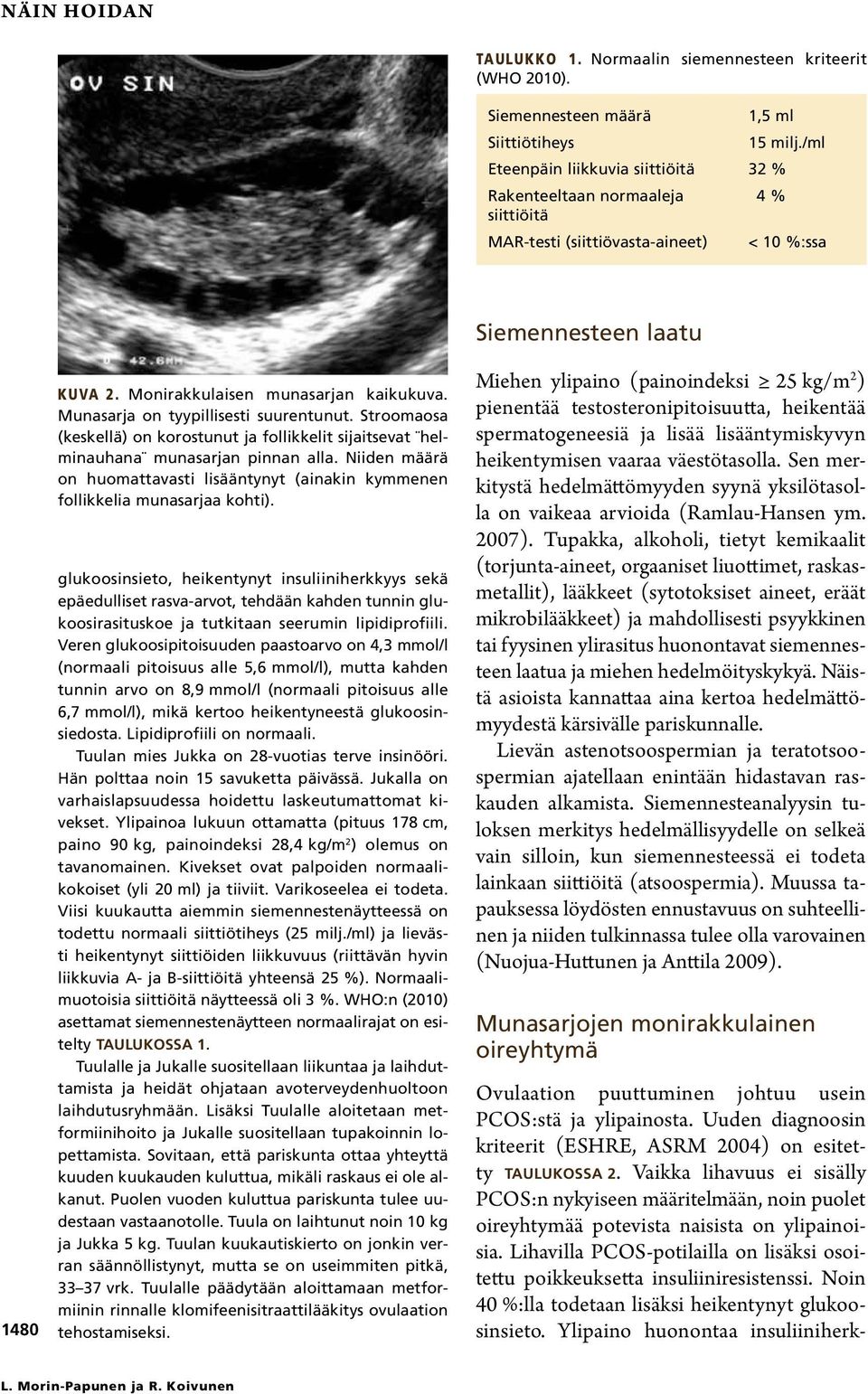 Munasarja on tyypillisesti suurentunut. Stroomaosa (keskellä) on korostunut ja follikkelit sijaitsevat helminauhana munasarjan pinnan alla.